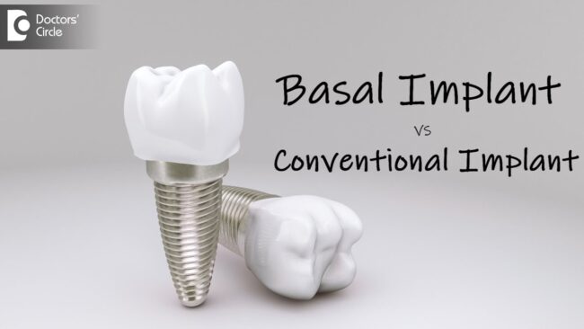 Basal Implant vs. Conventional Implant Basal Implant vs. Conventional Implant