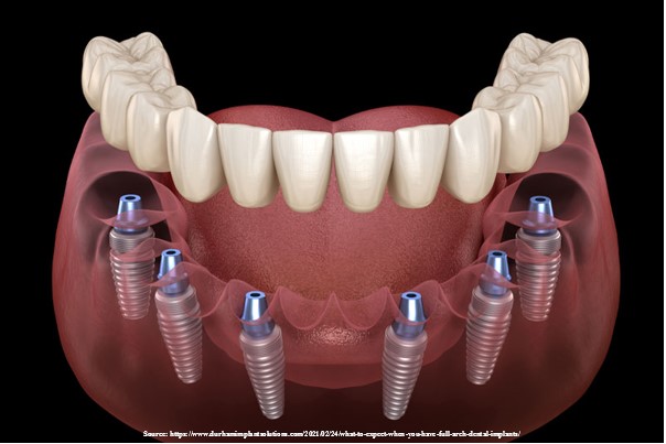 Full Arch Dental Implantation