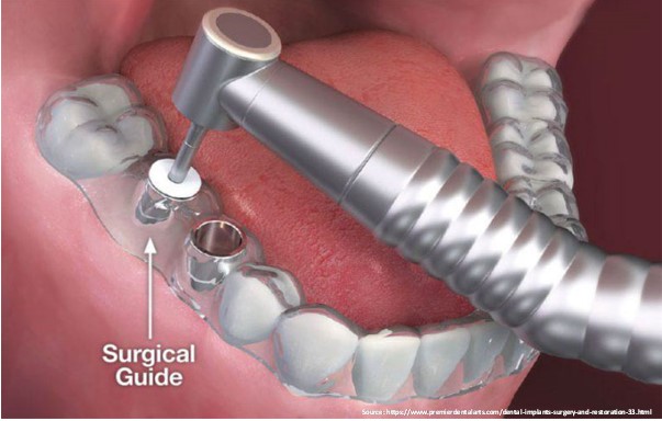 Overview of Guided Implant Surgery