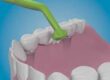 Teeth Cleaning After Dental Implants