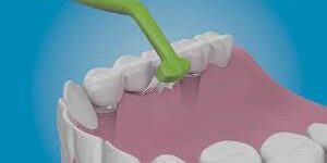 Teeth Cleaning After Dental Implants