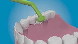 Teeth Cleaning After Dental Implants Teeth Cleaning After Dental Implants