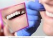 Three-Unit Bridge Vs. Implant