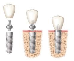 What are Conventional Implants