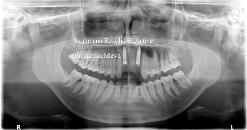 Missing Anterior Teeth With Buccal Bone Loss Replaced With Implant ...